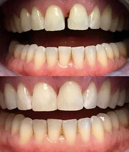 Before & After