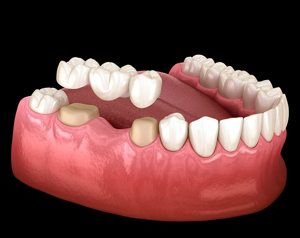 Custom dental bridges in Manhattan, NYC at Stuyvesant Dental, designed to blend seamlessly with natural teeth.