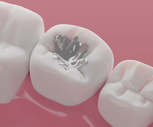 Tooth-colored dental fillings in Manhattan, NYC at Stuyvesant Dental, repairing cavities and preserving natural tooth structure.