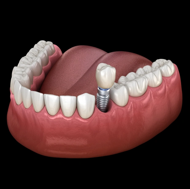 Natural-looking dental implants at Stuyvesant Dental, dentist in Manhattan NYC offering permanent tooth replacement solutions.