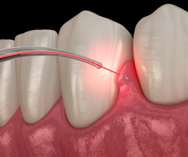 Advanced laser dentistry at Stuyvesant Dental in Manhattan, NYC, reducing discomfort and improving treatment outcomes.