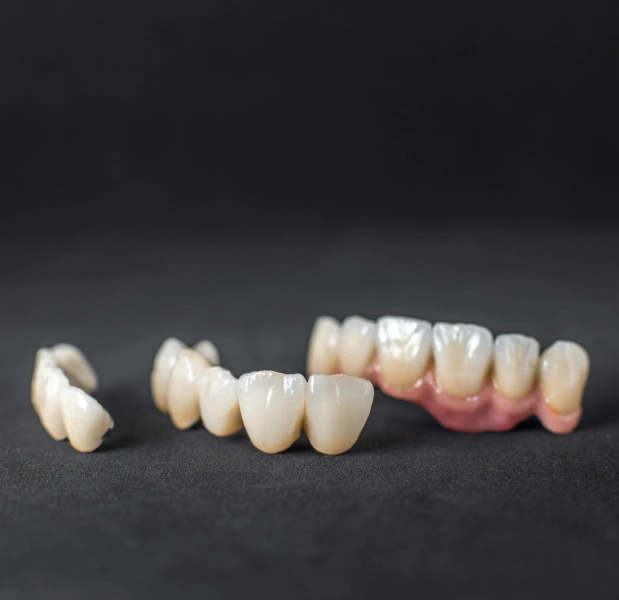 Cosmetic porcelain crowns in Manhattan, NYC at Stuyvesant Dental, enhancing both strength and appearance of teeth.