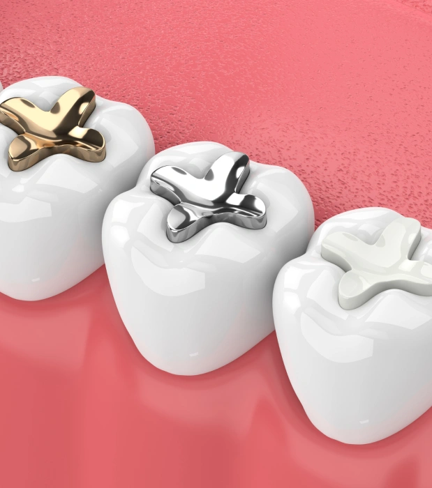 Composite dental fillings in Manhattan, NYC at Stuyvesant Dental, repairing cavities while blending seamlessly with natural teeth.