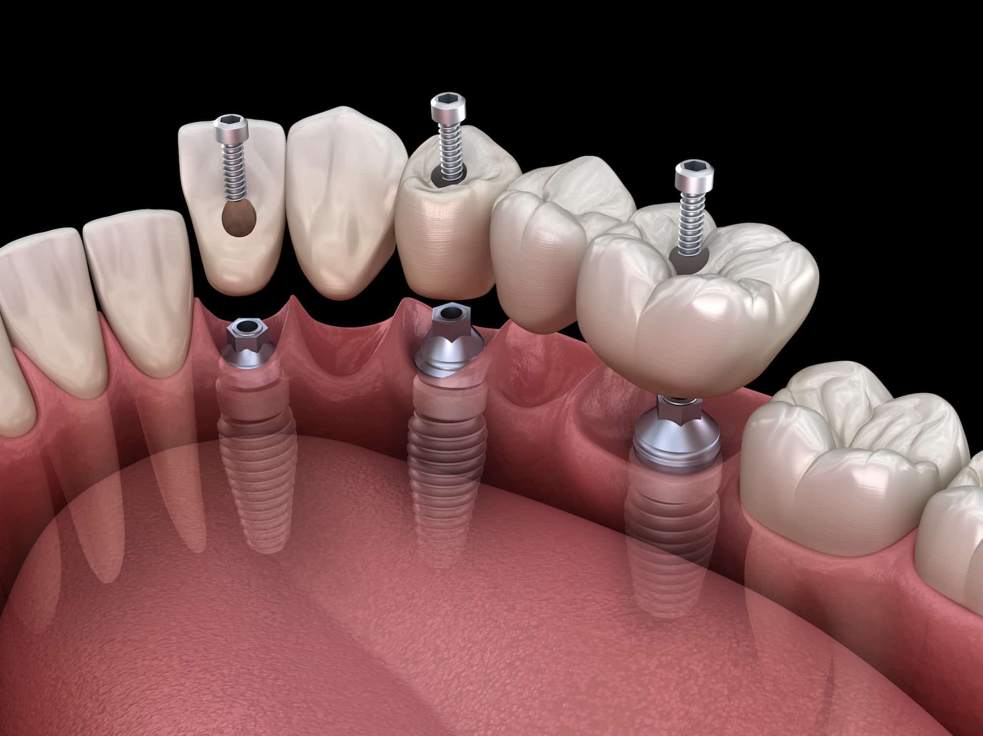 dental bridge on 3 teeth implants