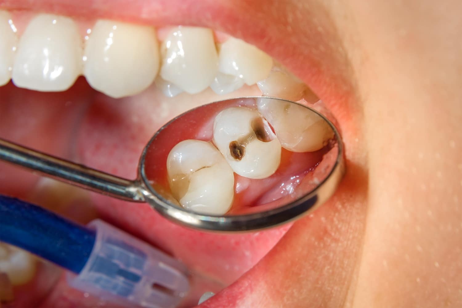 why do cavities hurt