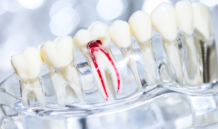 Necessity of root canal to save teeth