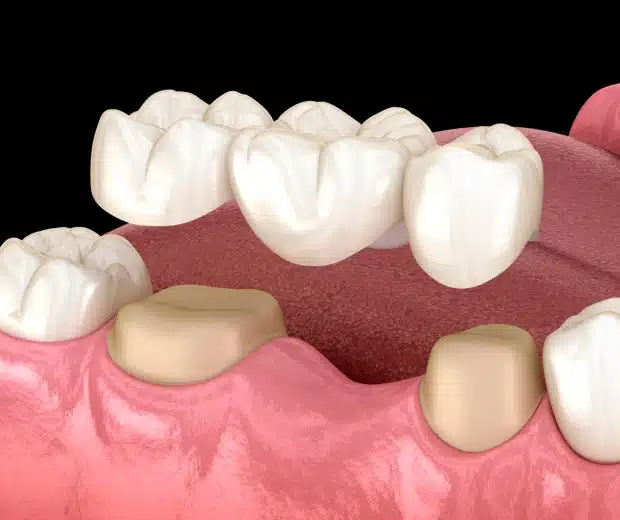 Crowns & Bridges treatment at Thrive Family Dentistry of Auburn in Auburn, AL