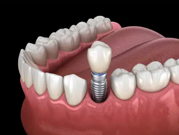 Replace missing teeth with dental implants treatment at Thrive Family Dentistry of Auburn in Auburn, AL