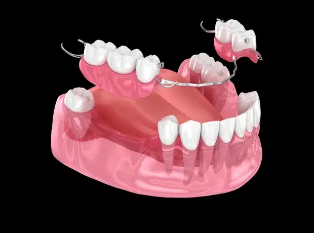 Missing tooth replacement wih dentures and Partials in Auburn, AL