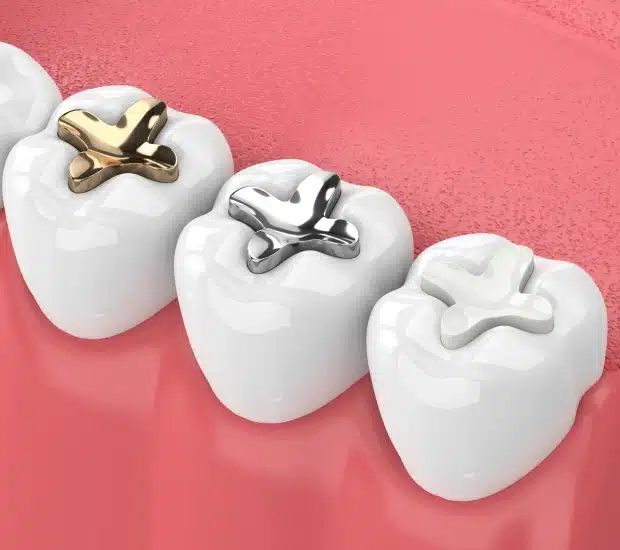 Tooth Colored Fillings at Thrive Family Dentistry of Auburn in Auburn, AL