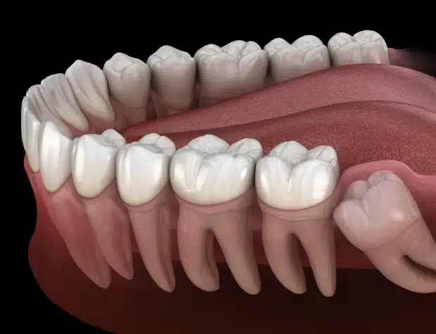 wisdom teeth removal at Thrive Family Dentistry of Auburn in Auburn, AL