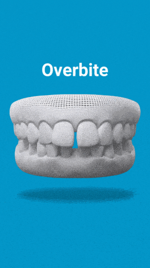 overbite