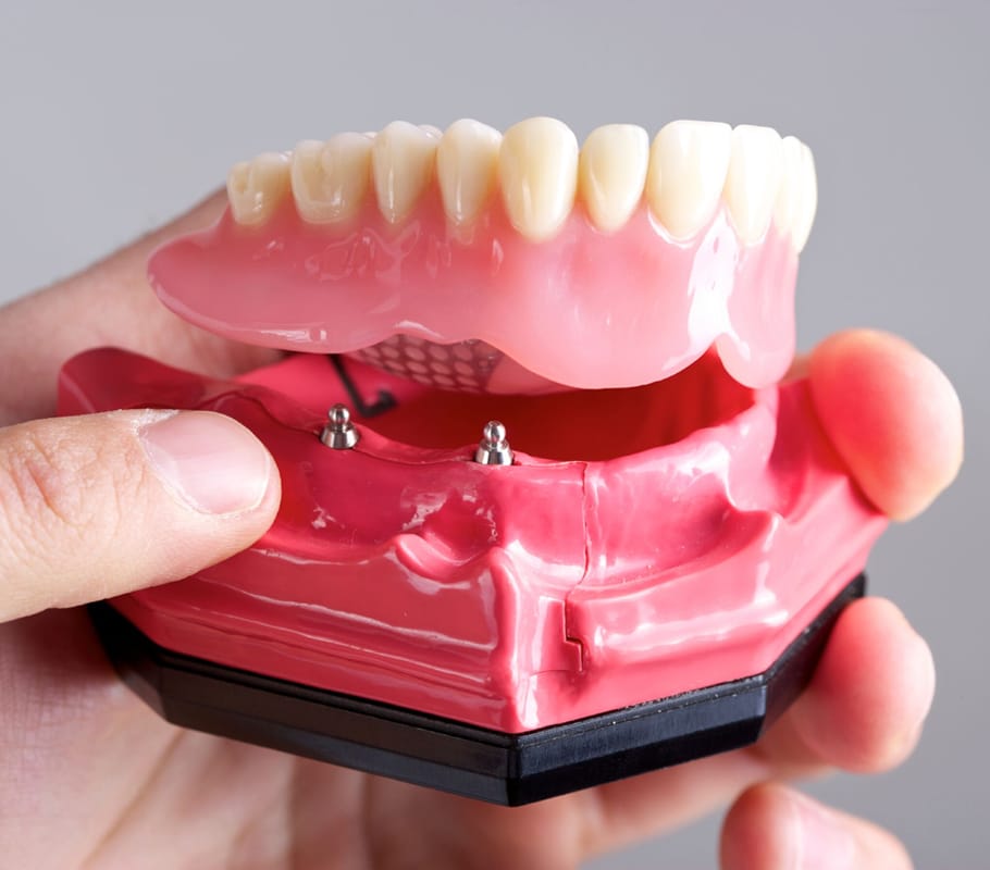 Close up of dental implant model with pink gum base