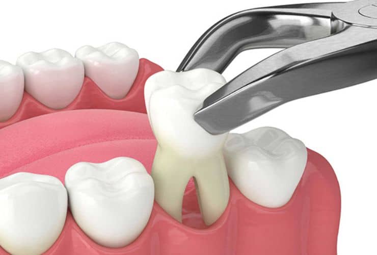 Damaged tooth extractions at Thrive Family Dentistry in Auburn, Alabama