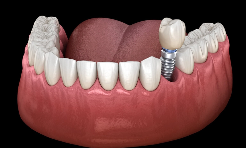 How Much Pain Can I Expect from Dental Implant Surgery
