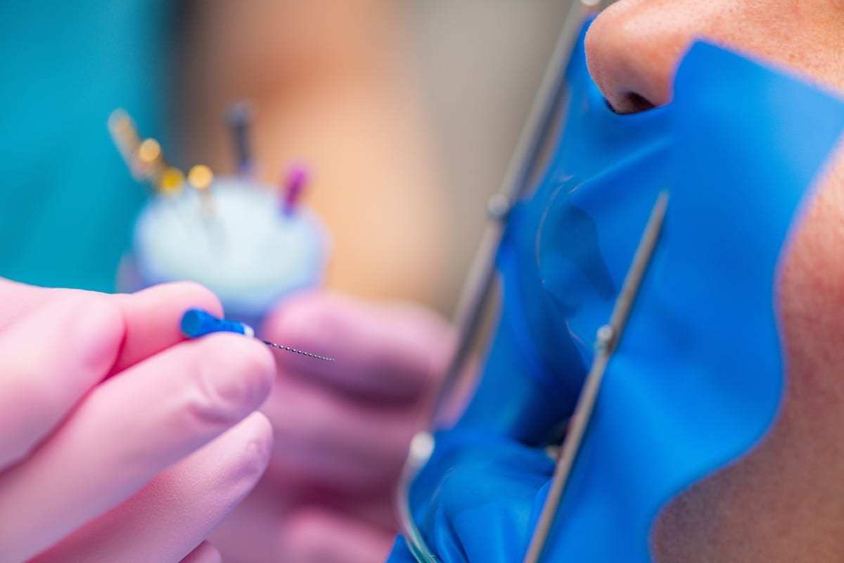 Root Canal Treatment in Spokane