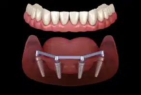 All-on-4 Implants
