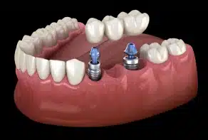 Implant-Supported Bridges