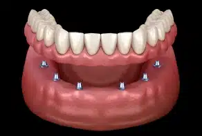 Implant-Supported Dentures
