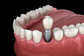 Single-Tooth Implants
