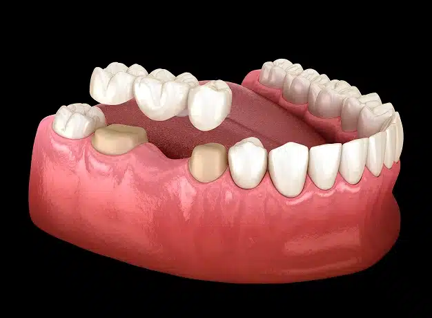 Dental Bridges in Waldorf