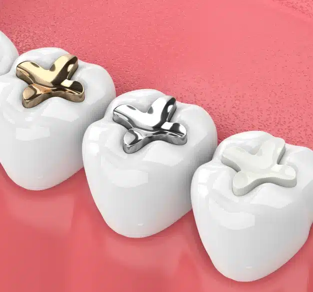 Tooth-colored Fillings in Waldorf