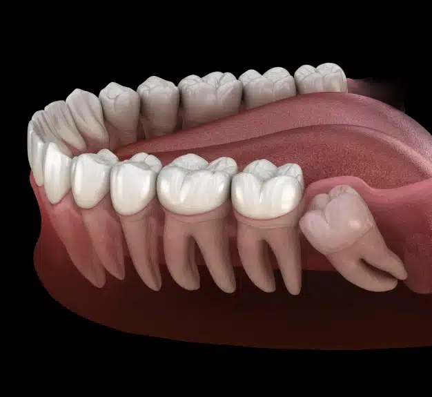 Wisdom Teeth Removal in Waldorf