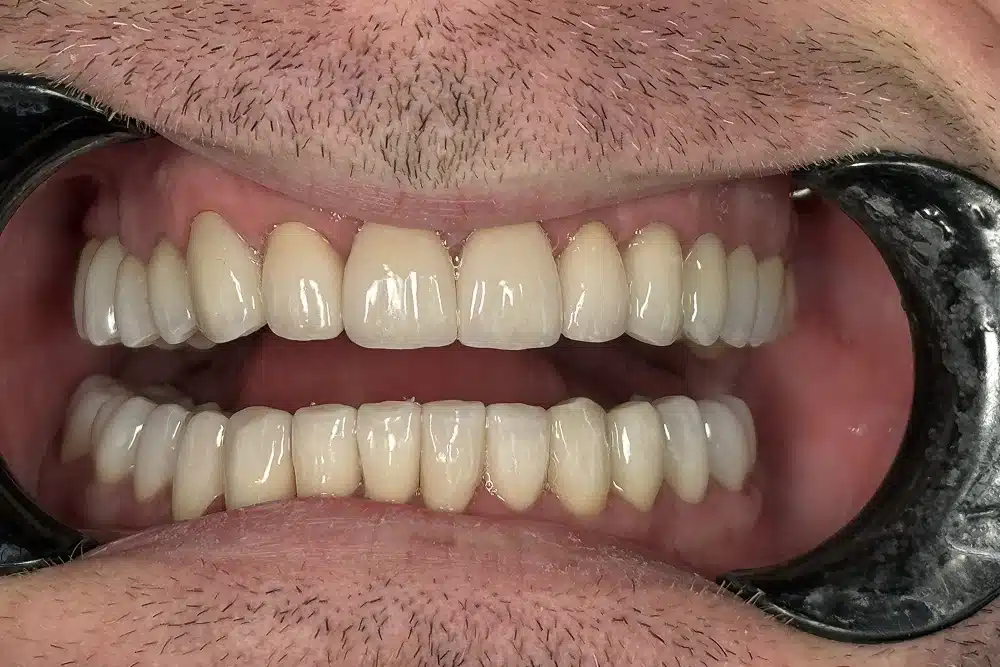 Cosmetic veneers after treatment at TRU Dentistry SoCo in South Austin, TX
