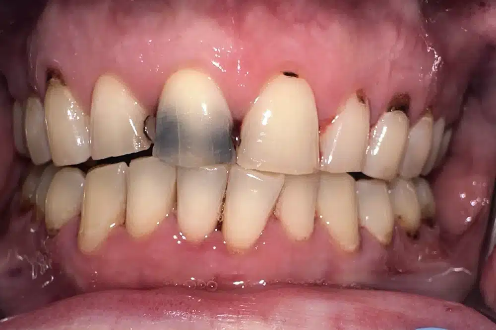 Cosmetic veneers before treatment at TRU Dentistry SoCo in South Austin, TX