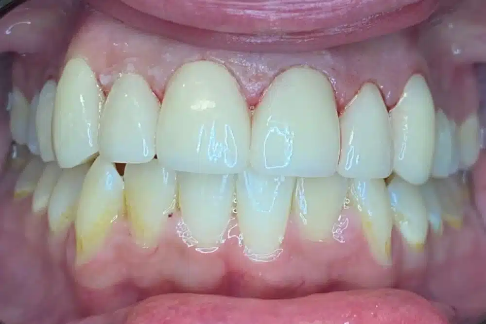 Dental crowns after treatment at TRU Dentistry SoCo in South Austin, TX
