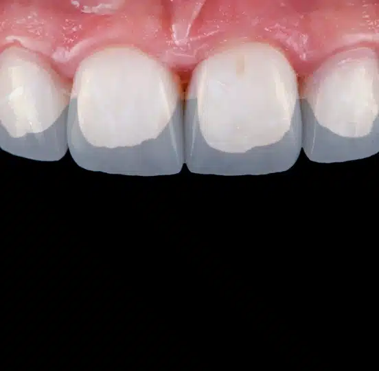 Close-up of front teeth before dental bonding treatment at TRU Dentistry SoCo in South Austin, TX