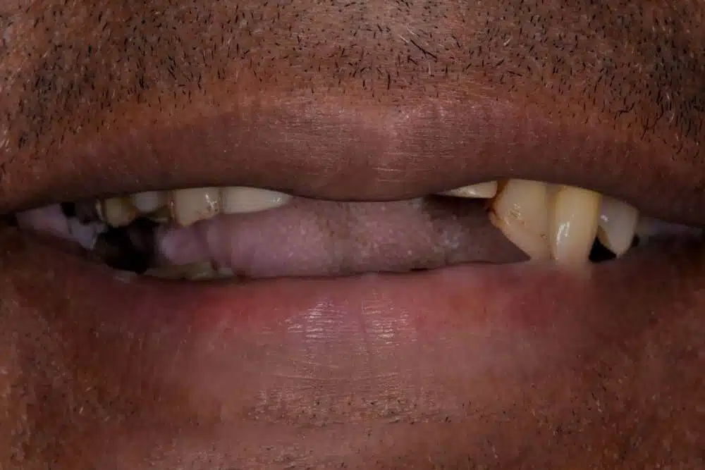 Dentures before treatment at TRU Dentistry SoCo in South Austin, TX