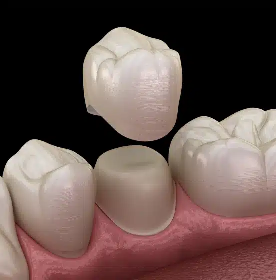3D illustration of a dental crown being placed on a tooth at TRU Dentistry SoCo in South Austin, TX