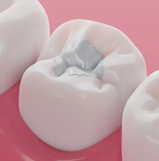 3D illustration of a tooth-colored composite dental filling at TRU Dentistry SoCo in South Austin, TX