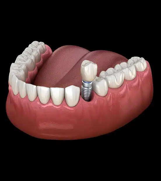 3D illustration of a dental implant replacing a missing tooth at TRU Dentistry SoCo in South Austin, TX