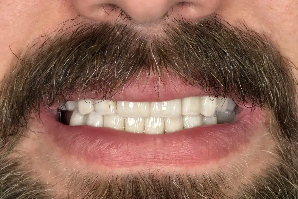 Smile gallery veneers after treatment at TRU Dentistry SoCo in South Austin, TX
