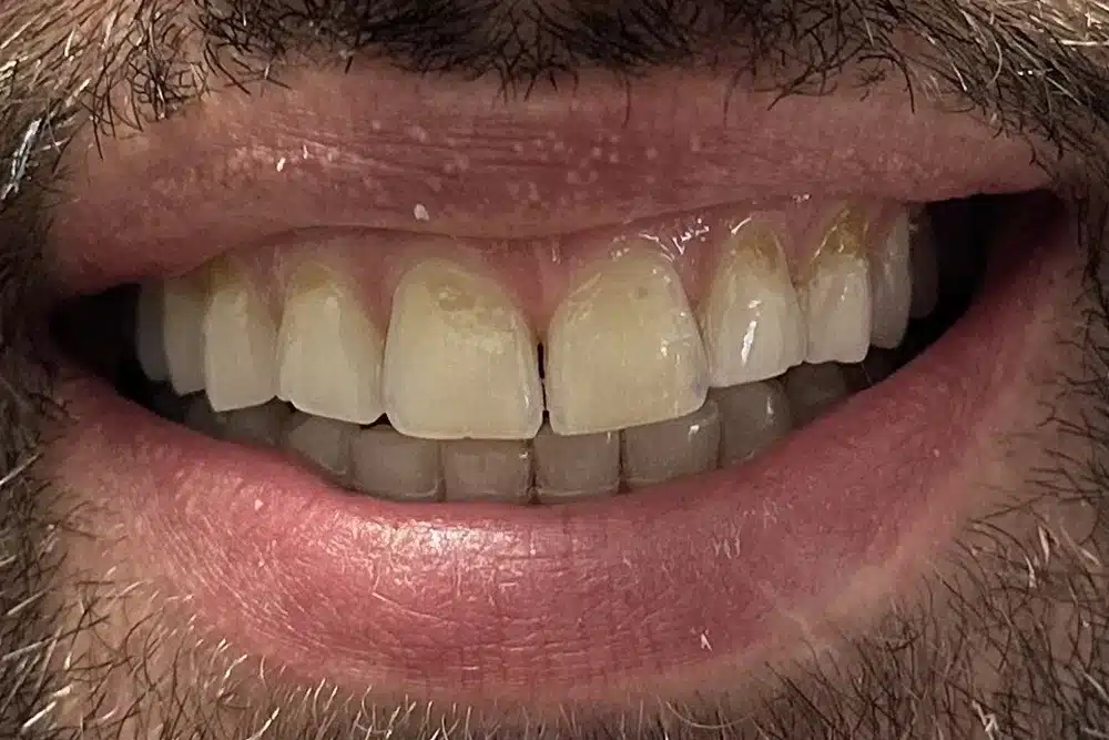Veneers before treatment at TRU Dentistry SoCo in South Austin, TX