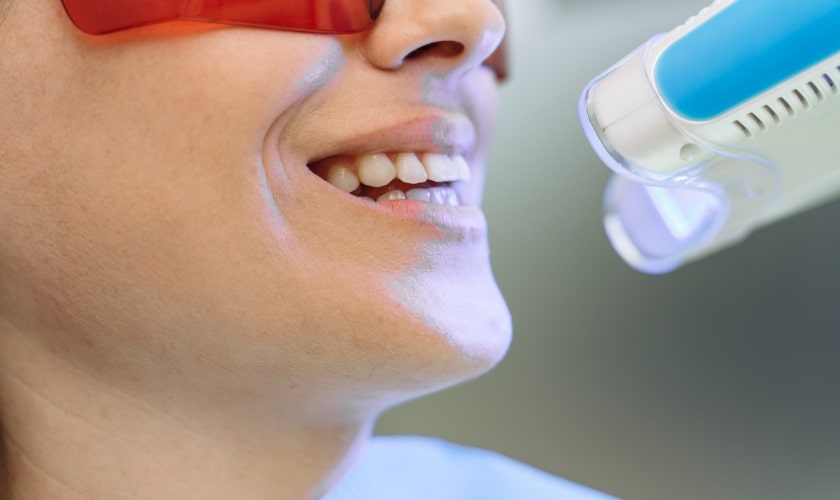 Teeth Whitening for Intrinsic Tooth Stains