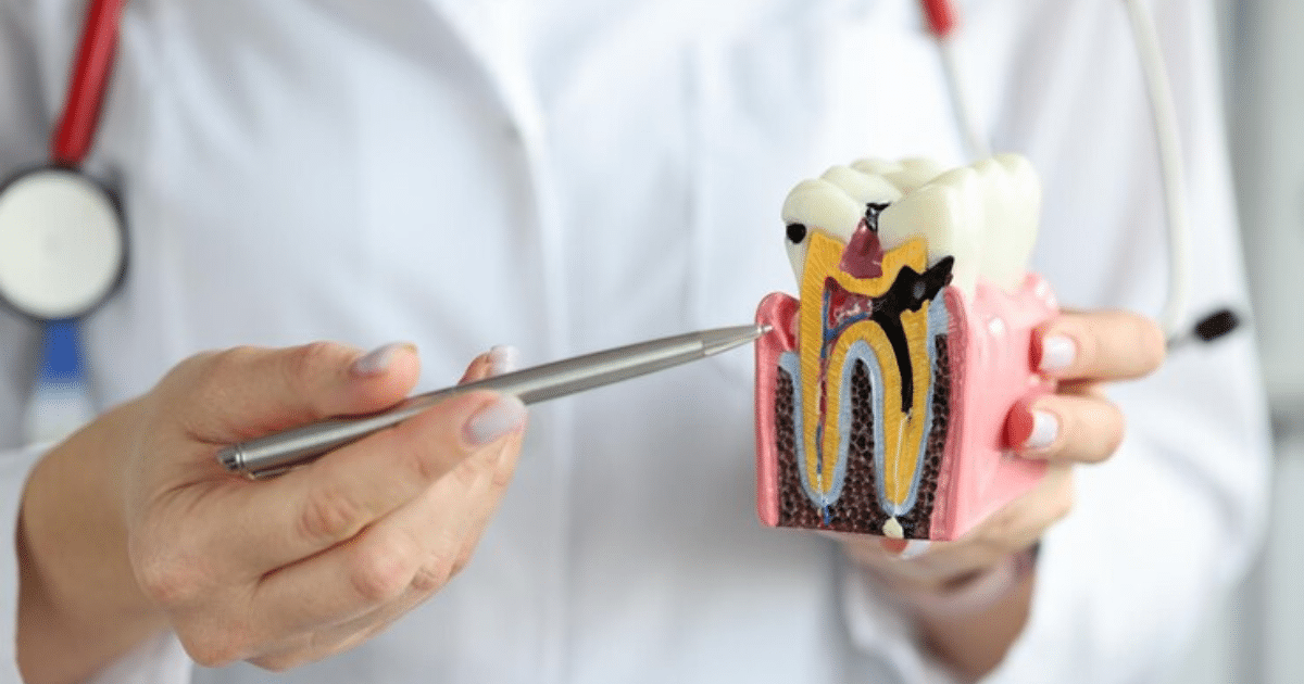 common myths about root canals in charlotte