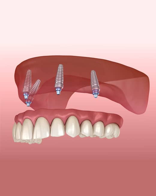 Snap-In Implant Dentures in Charlotte NC