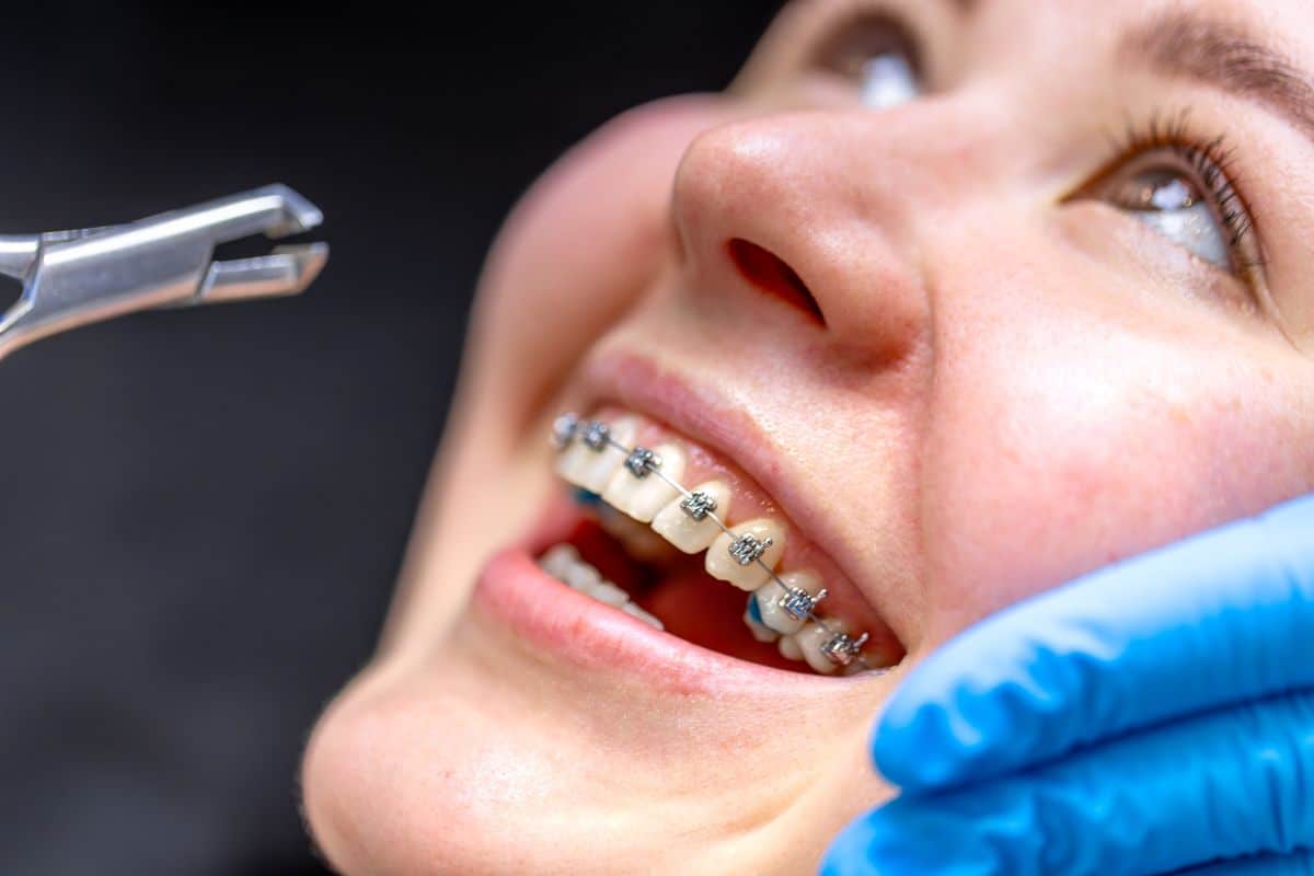 How Do Dental Braces Straighten Crooked Teeth?