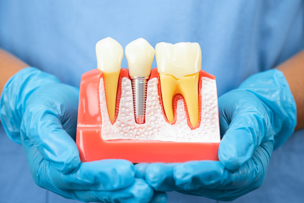 Why Proper Planning Matters Before Full Mouth Dental Implant Treatment?
