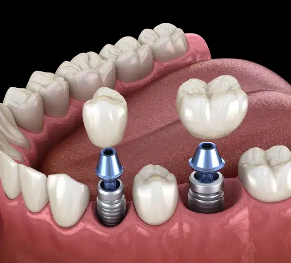 Dental Implants