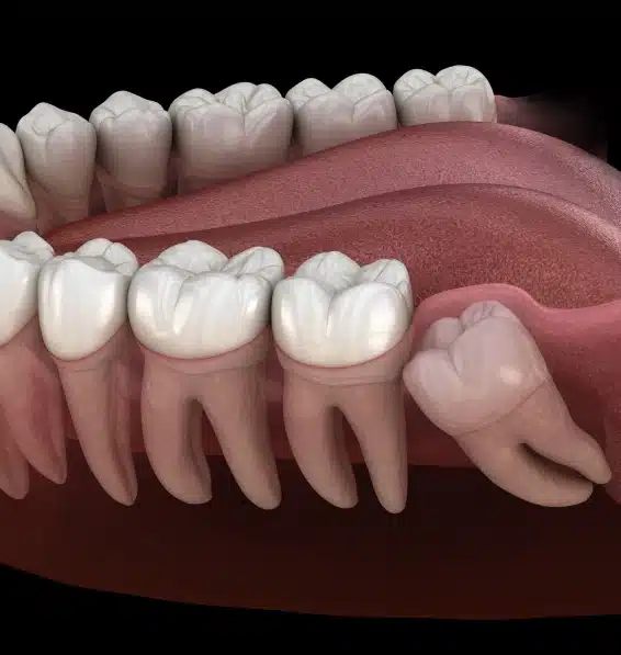 wisdom tooth