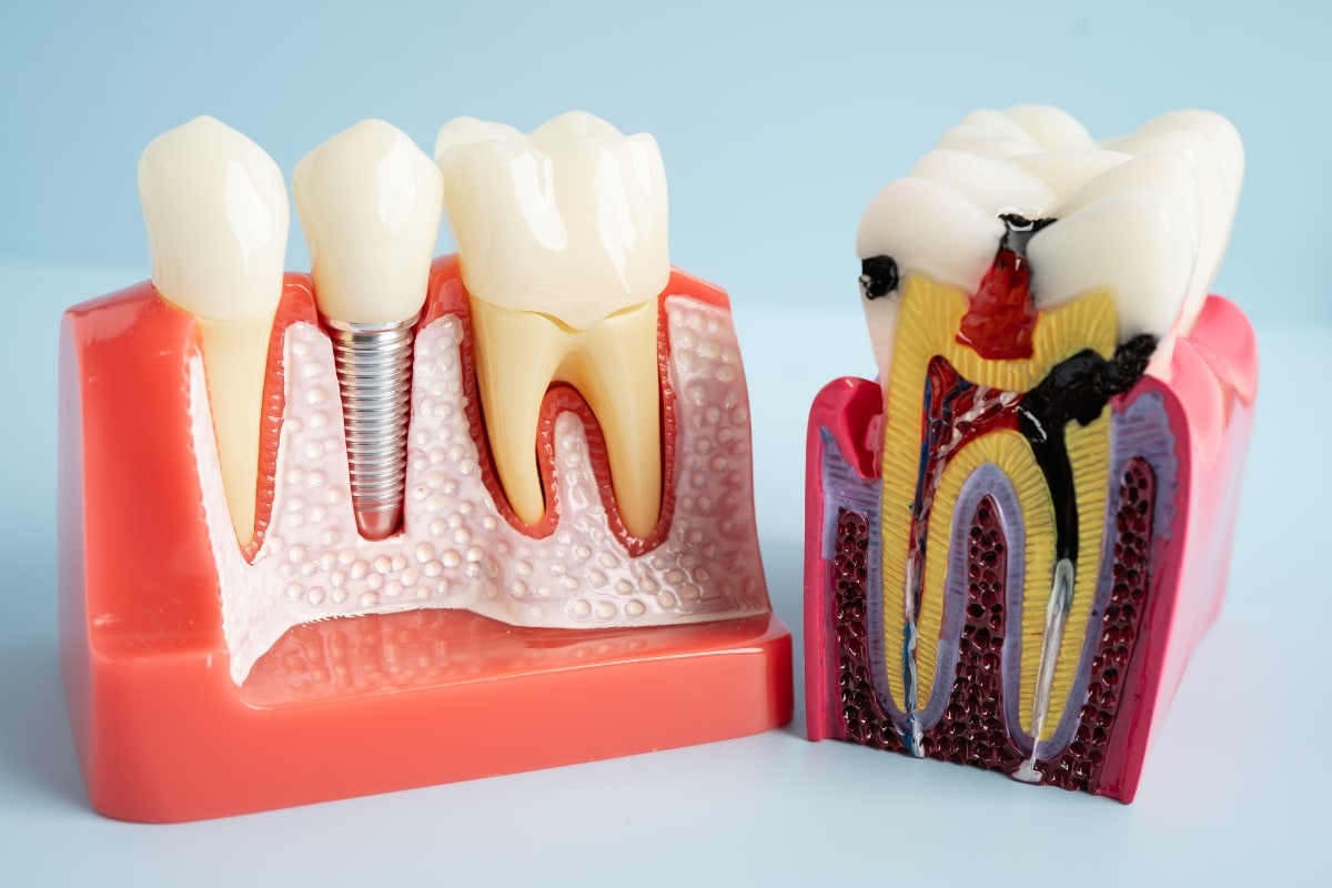 dental implants in Clarksburg