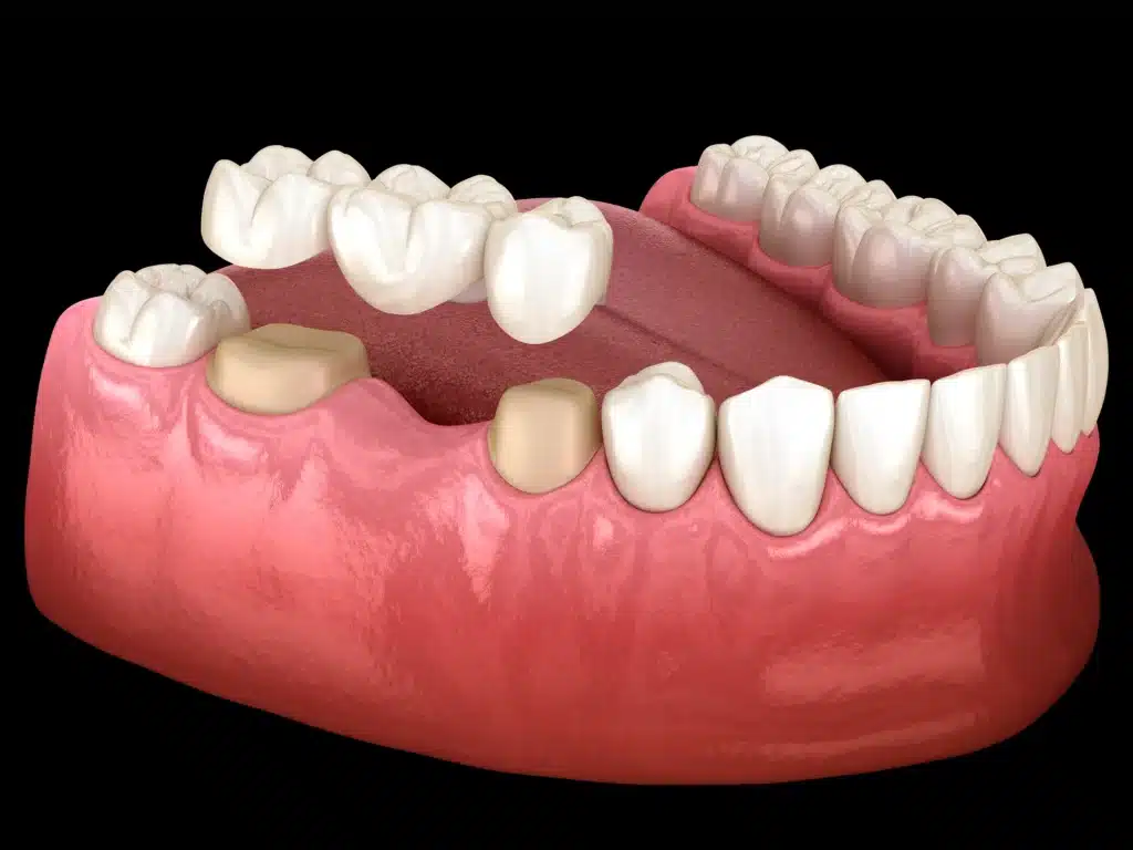 Dental Crowns