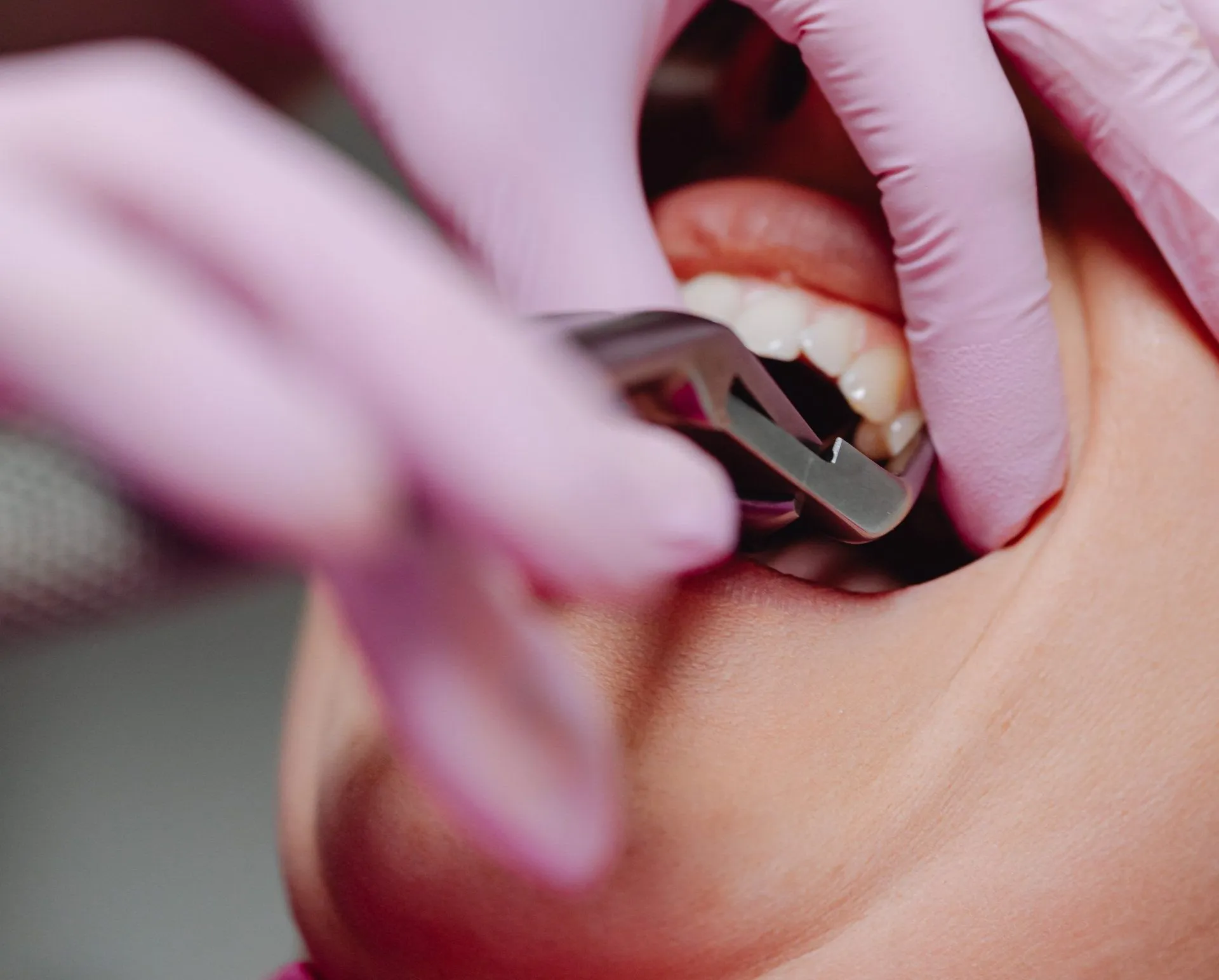 Enhance Your Smile With Dental Crowns & Bridges
