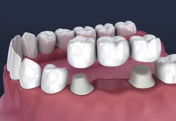 dental crowns and bridges in charlotte