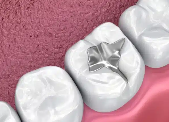 dental fillings in charlotte