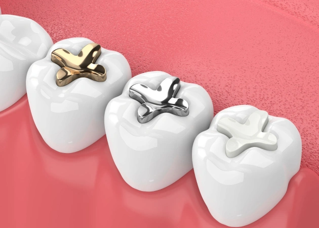 Dental sealants at Valley Dental Riverview helping protect teeth from cavities